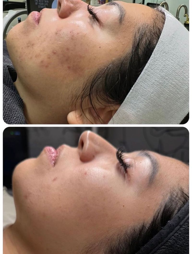 Acne treatment before and after: client skin showing clearer, calmer results