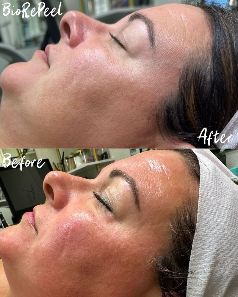 BioRePeel before and after: client skin before and after a BioRePeel treatment by Paige